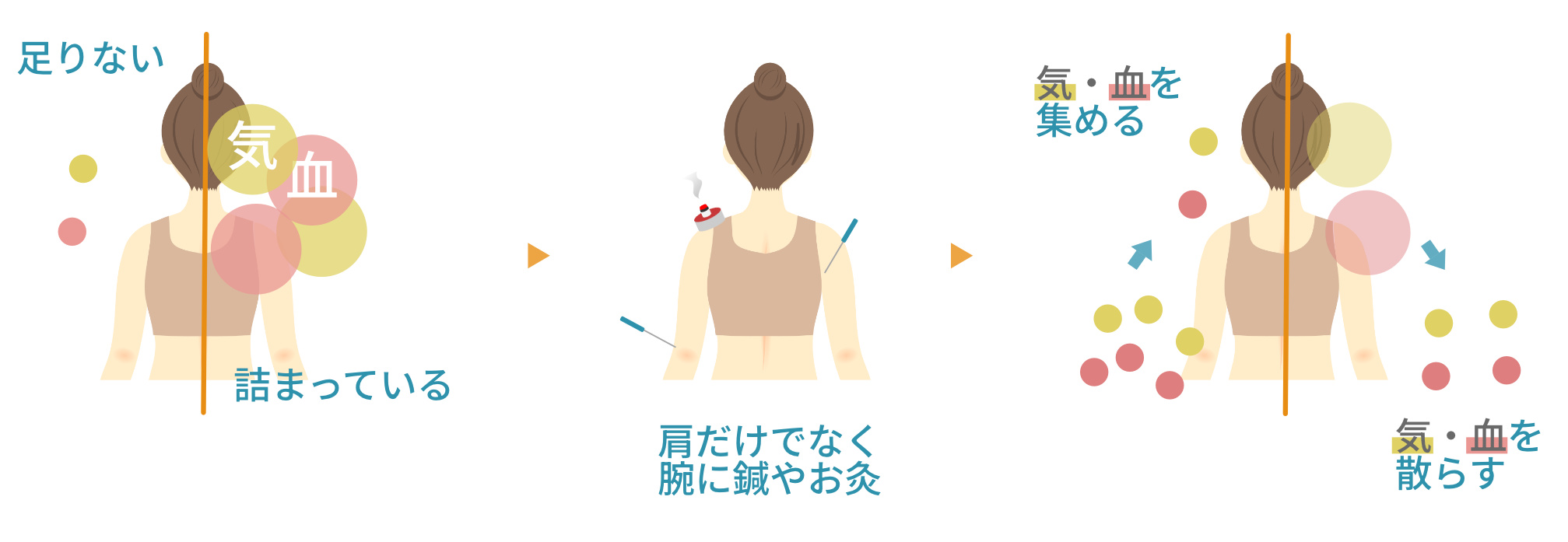 体のエネルギーと血液が片側に偏ったり滞ったりしている女性の背中へ、鍼やお灸を使って施術し、エネルギーや血液を全身にバランス良く行き渡らせる様子を示すイラスト