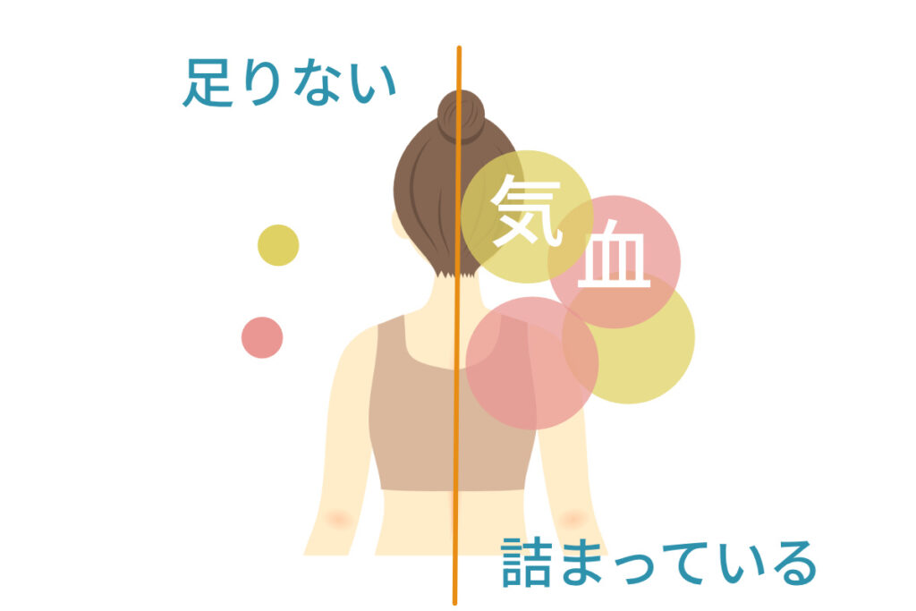 女性の背中を左右に分けた図 左側は気や血が不足している状態 右側は気や血が滞り詰まっている状態