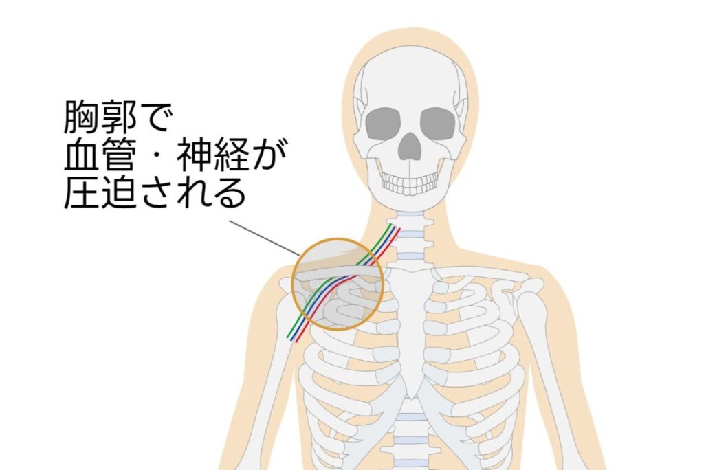 胸郭出口症候群